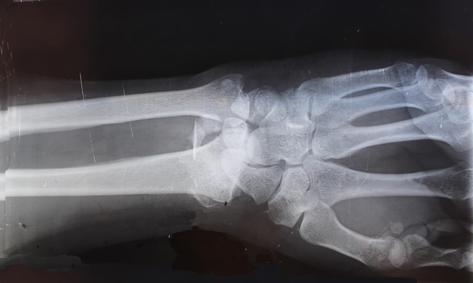 A radiograph of a human wrist and hand